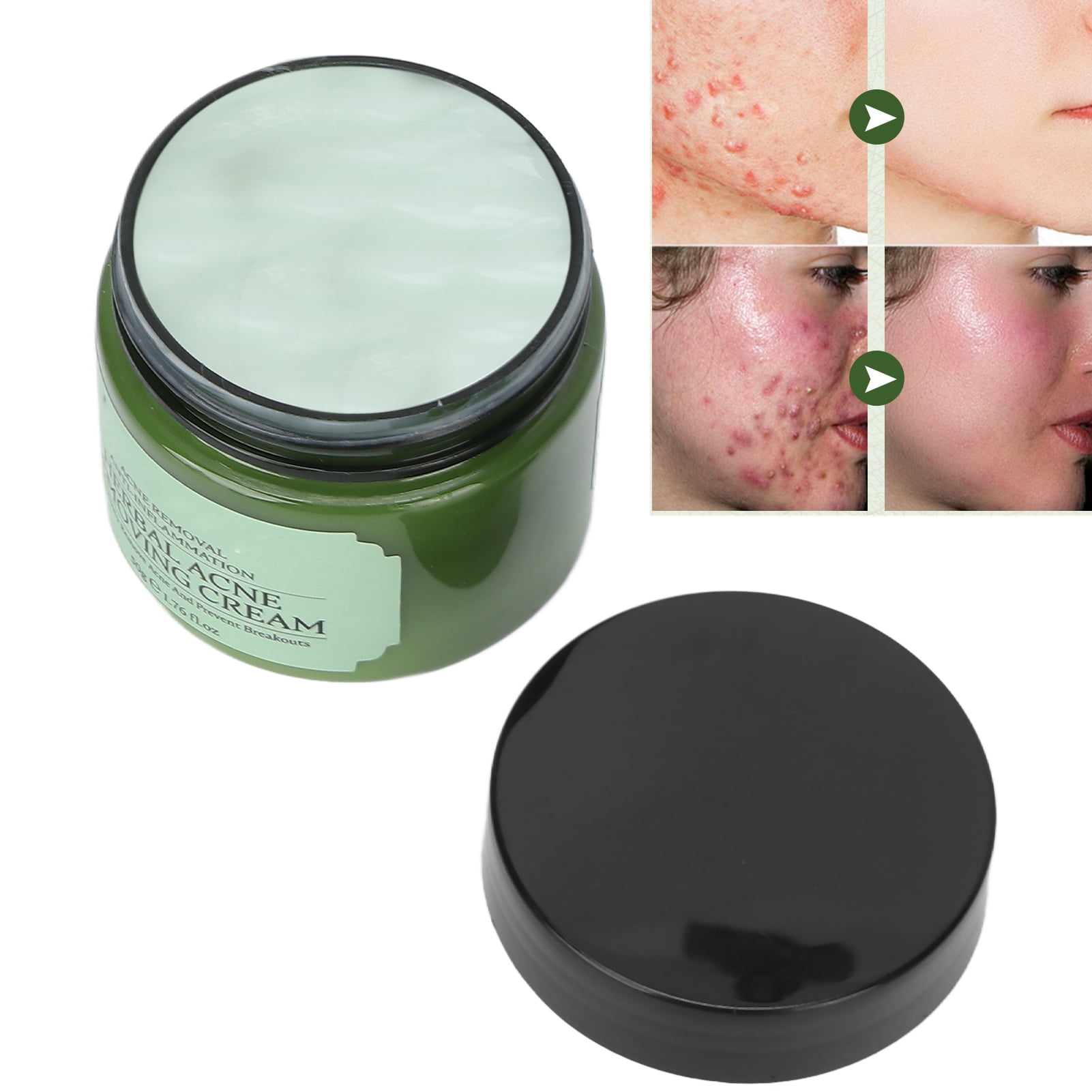 Ymiko Face Acne Cream Tea Tree Extracts Fade Acne Marks Control Oil Skin Repairing Blains Treatment Cream 50g,Skin Repairing Cream,Skin Acne Cream