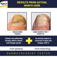thumbnail image 3 of Gel aclarador de uñas con hongos NONYX, 120 ml, mejora al 90% las uñas de los pies, 3 of 5