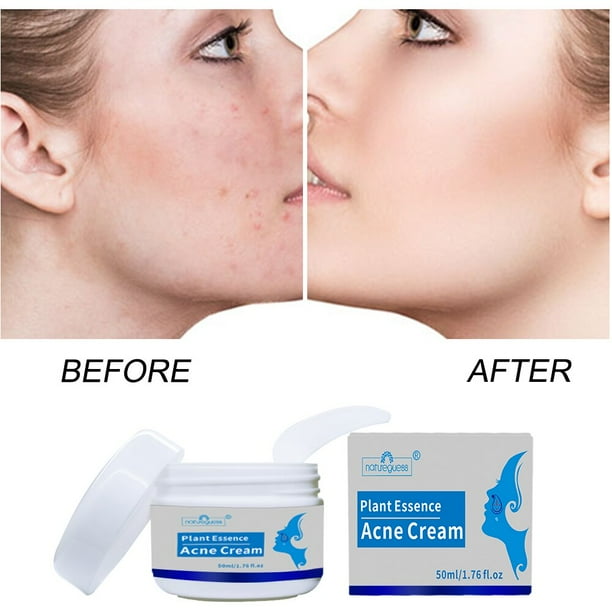 Crema eliminadora de acné, tratamiento blanqueador para el cuidado facial, Control de aceite, encogimiento de poros, cicatriz de acné, espinillas, 50g Fivean unisex
