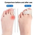 thumbnail image 4 of Cushioned Bandages For Toe Alignment, Corrects Hammertoes And Overlapping Toes With Orthopedic Separator, Suitable For Various Footwear (2Pcs), 4 of 6