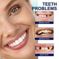 thumbnail image 2 of Braces Beauty Teeth Guard Teeth At Night Sleep Bite Anti-Grinding Teeth Clean Teeth Protection Teeth Invisible Braces, 2 of 5