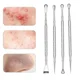 thumbnail image 4 of 1 pieza de removedor de puntos negros, herramienta para hacer estallar granos, tratamiento para eliminar el acné, herramienta para hacer estallar puntos blancos, extractor de granos, imperfecciones de, 4 of 5