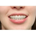 thumbnail image 2 of Girl Smiles with Braces Wall Mural by Wallmonkeys Peel and Stick Graphic (18 in W x 12 in H) WM125249, 2 of 4