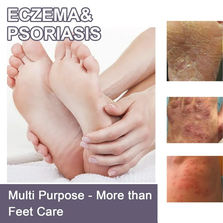 Early stage athlete s foot celular peeling