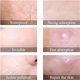 thumbnail image 3 of 108 PCS Acne Patches, Day and Night Use 2 in 1 Acne Pimple Patch, Invisible Effective Hydrocolloid Pimples Acne Absorbing Anti-Acne Patch, Waterproof Face Acne Stickers, 3 of 5