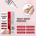 Toe Nail Fungus Treatments,Toenail Fungus Treatment Extra Strength