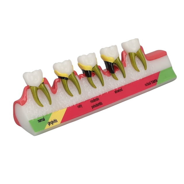 Modelo De Enfermedad Periodontal, Modelo De Dientes De Enfermedad Periodontal De Alta Simulación Entender Mejor Mostrar Claramente Diferentes Etapas Para Material