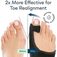thumbnail image 4 of Bunion Corrector for Big Toe Straightener Orthopedic Bunion Splint Non-Surgical cs, 4 of 5