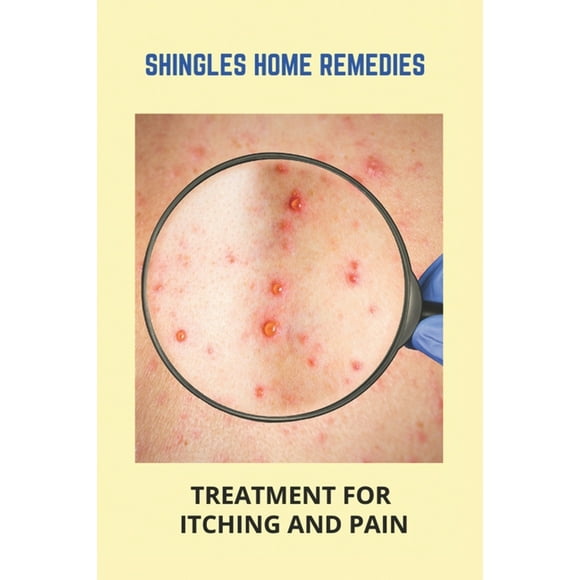 Treatment Shingles
