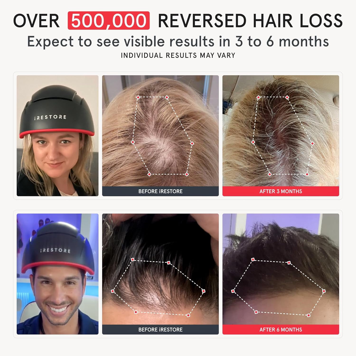 iRestore Elite - Laser Red Light Therapy for Hair Growth System - FDA Cleared