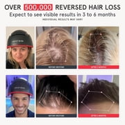 iRestore Elite - Laser Red Light Therapy for Hair Growth System - FDA Cleared
