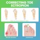thumbnail image 2 of 8Pcs Toe Separators for Overlapping Toes, Silicone Big Toe Straighteners for Bent Gel Spacers to Correct Your Hammer Toe Dividers Bunions Pain Relieve Spreaders for Men Women(S＋L), 2 of 5