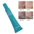 thumbnail image 4 of Acne Removal Gel Acne Marks Fading Gel Skin Repair Gel Tea Tree Acne Treatment Gel Tea Tree Acne Scar Removal Gel Mild Oil Control Skin Acne Treatment Repair Gel 30g ANGGREK Otros, 4 of 8
