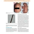 thumbnail image 4 of Pre-Owned Neonatal and Infant Dermatology, 9781455726387, 1455726389, Hardcover, 3 edition, 4 of 4
