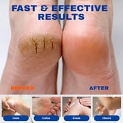 Mooyam Urea Cream 40% plus Salicylic Acid 2%, Foot & Hand Cream for Rough Dry Cracked Skin, Urea Lotion for Feet 5.29 oz