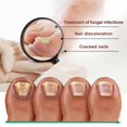thumbnail image 3 of 30ml X3 Toenail Repair Liquid Soft Nail Repair Liquid Cleaning Repa, 3 of 4