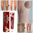 thumbnail image 1 of Ungüento de masaje para venas varicosas para aliviar los vasos sanguíneos abultados en las piernas, 1 of 3