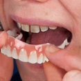 thumbnail image 1 of Extra Thin Fake Bright White Tooth Veneers Silicone Soft Safe Adhesive Denture Hide Shade Braces Comfortable Teeth Orthodontic, 1 of 5