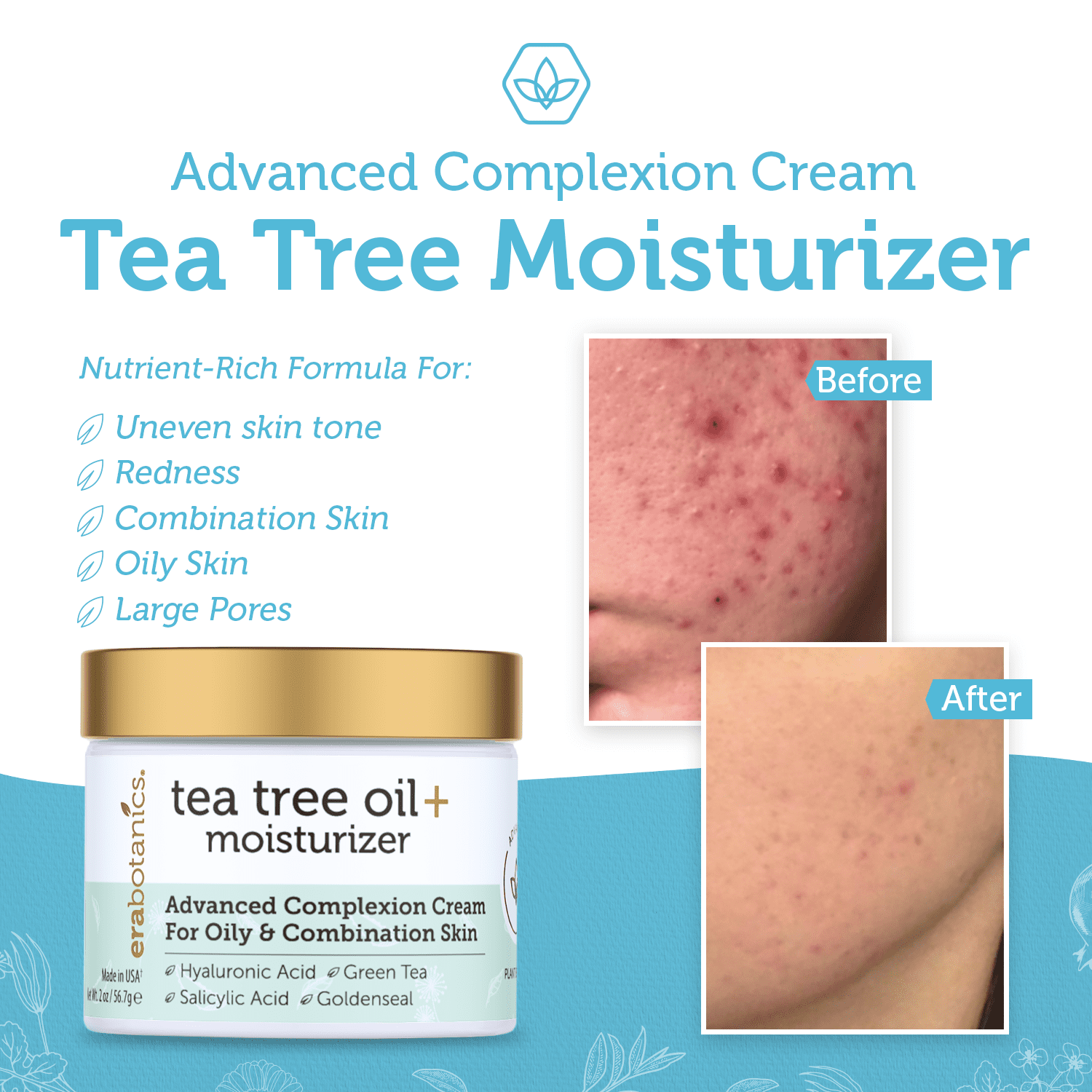 Era Organics Tea Tree Oil Face Cream - For Oily, Acne Prone Skin, Extra Soothing & Nourishing Non-Greasy Botanical Facial Moisturizer with 7X Ingredients For Rosacea, Cystic Acne, Blackheads & Redness