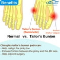 thumbnail image 5 of Chiroplax Tailor's Bunion Corrector Pads Bunionette Pain Relief Pinky Toe Straightener Separator Cushion Splint Protector Shield Spacer (4 Pads, Shims - Size Regular), 5 of 6