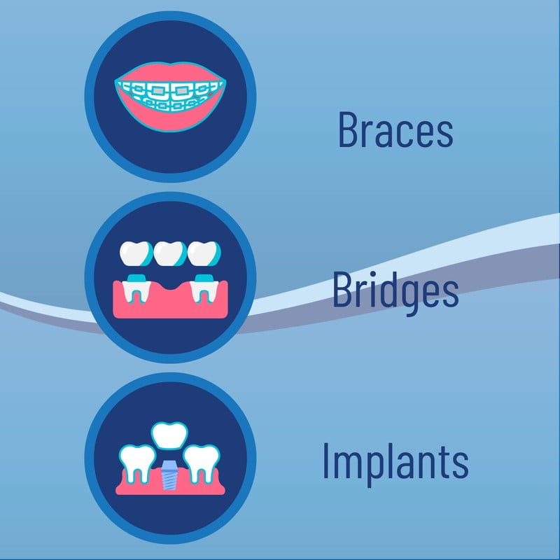 OrVance Threader Floss- Designed to Floss Through Braces, Bridges, and Implants –  30 Count (PACK OF 6)
