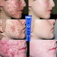 Cystic Acne Spot Cream Fast Acting Formula Cream for Clearing Severe