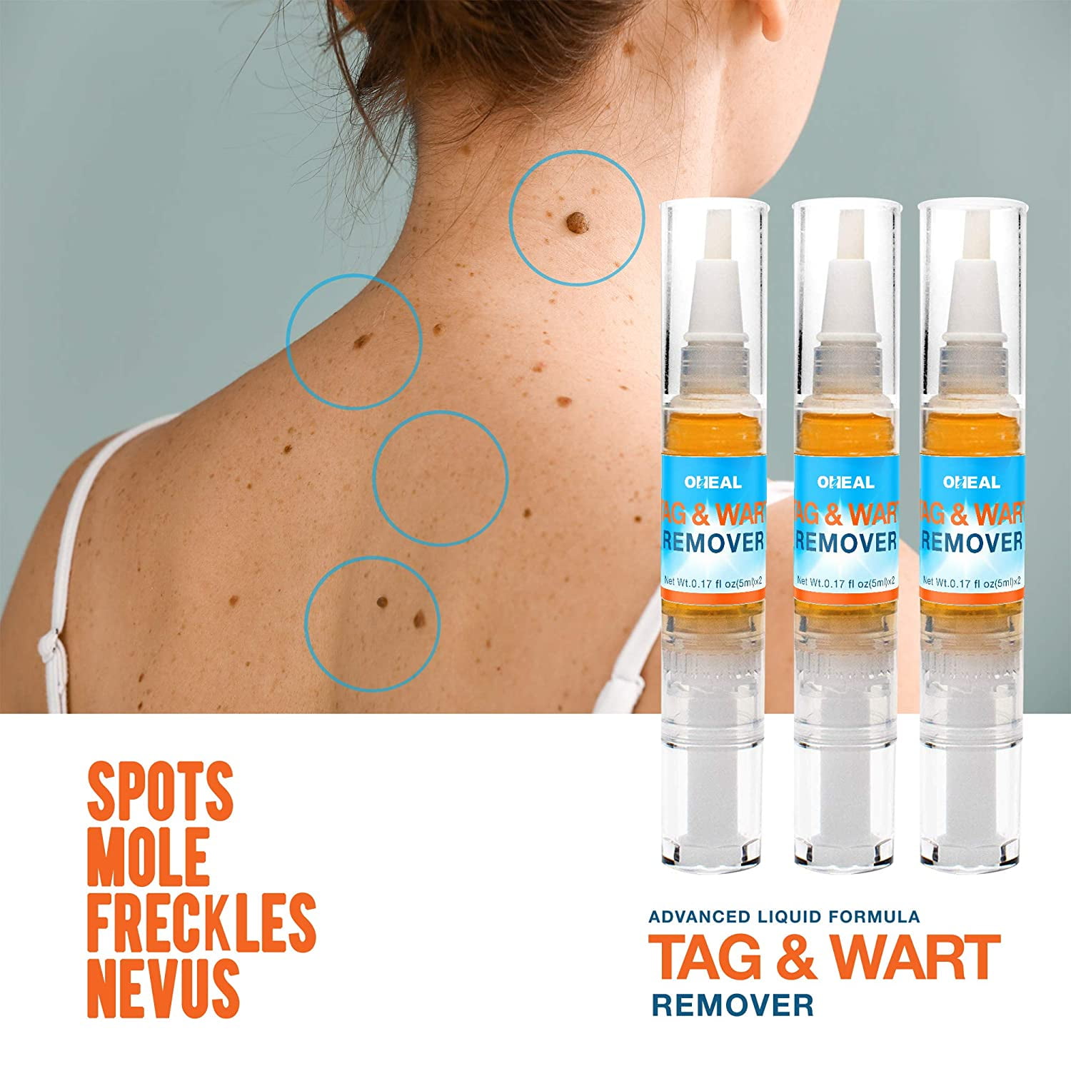 skin tag removal