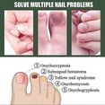 thumbnail image 4 of Lápiz reparador de uñas, 3 unidades, tratamiento para hongos en las uñas, cuidado de los pies, antiinfecciones por hongos en las uñas, eliminación de paroniquia en los pies, onicomicosis de los dedo, 4 of 5