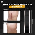 thumbnail image 4 of Skin Grip Medical Grade Silicone Scar Tape 1.6"x120" Roll -Increased Strength & Reduced Irritation - Silicone Scar Sheets For Face, Surgical Scars, C-Section, Keloid Treatment, Tummy Tuck - Black, 4 of 7