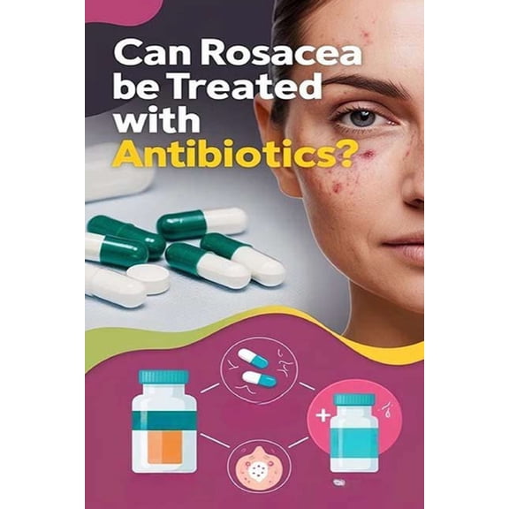 Can Rosacea Be Treated with Antibiotics?: Antibiotics can often be effective at treating rosacea symptoms in combination, (Paperback)