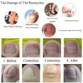 thumbnail image 1 of 10 Uds. Clip para alisar las uñas de los pies encarnadas corrección de las uñas de los pies Likrtyny Cuidado Belleza, 1 of 4