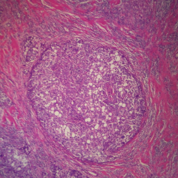 Human Adenocarcinoma Of Breast, Sec. 7 M H&E Microscope Slide