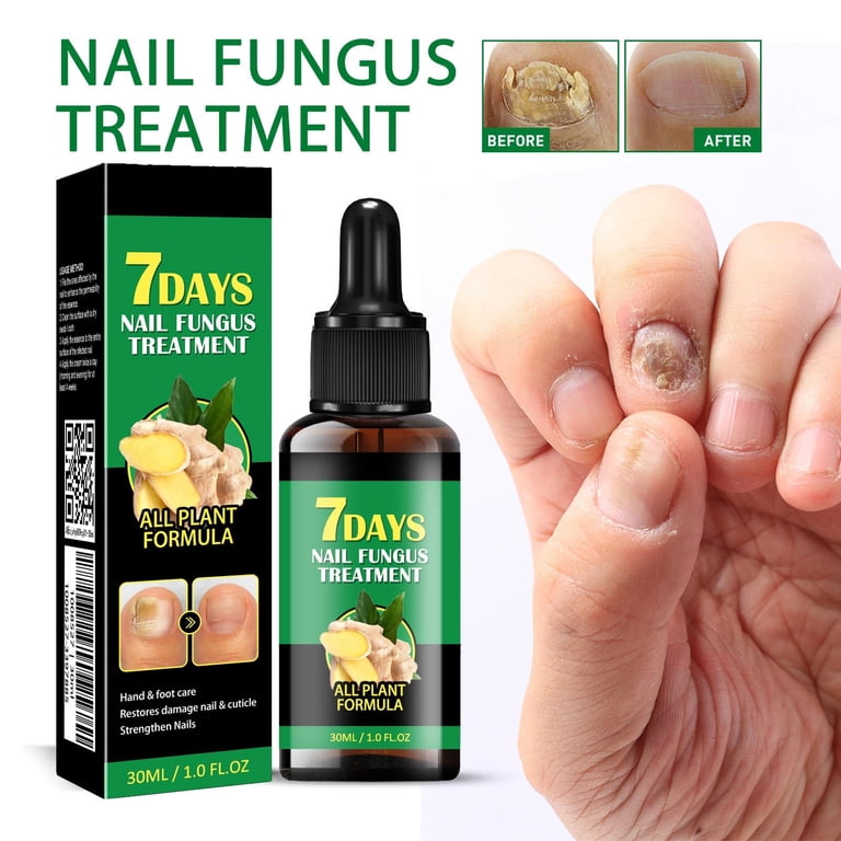 Mcolor 7 Days Nail Fungus Treatment Ginger Nail Treatment, Nail