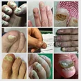 thumbnail image 5 of Hongo de uñas Extra fuerte para pies, cuidado de reparación de uñas, eliminación de hongos para dedos de los pies, antiinfección, nuevo, 5 of 5