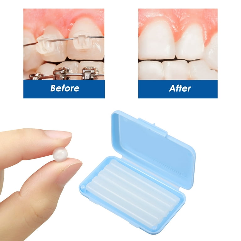 Orthodontic Wax corona.dothome.co.kr