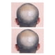 thumbnail image 2 of Man Bald Micropigmentattion Practice Skin Silicone Hairline Microblading Practice Pads for Scalp Practice, 2 of 4