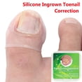 thumbnail image 1 of uds herramienta de corrección de uñas encarnadas de silicona Protector de uñas de los pies mangas del dedo gordo herramienta de corrección de paroniquia gruesa, 1 of 8