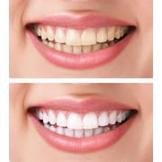 JARENGO Fake Teeth, 4PCS Dentures Teeth for Women and Men Veneers for Temporary Teeth Restoration Nature and Comfortable to Protect Your Teeth