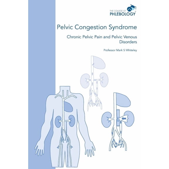 Pelvic Congestion Syndrome - Chronic Pelvic Pain and Pelvic Venous Disorders (Paperback)