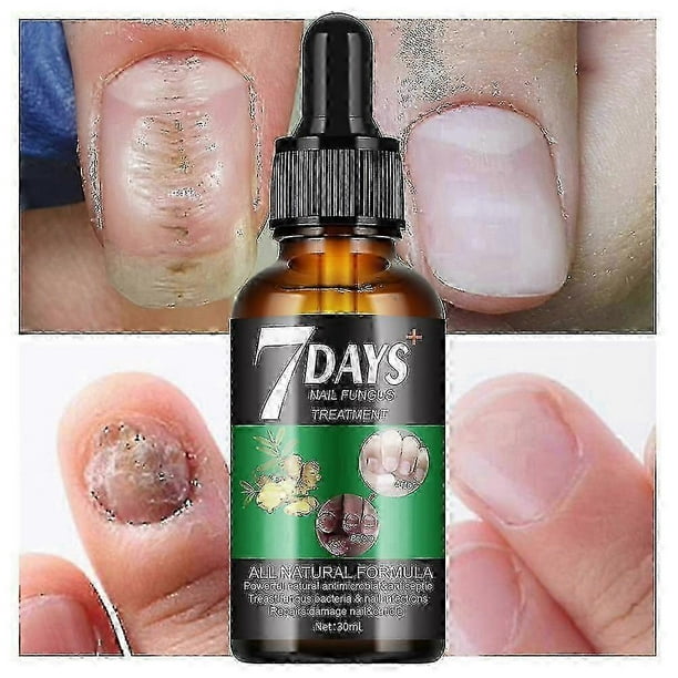 7 Days Nail Fungus Treatment, 7 Days Nail Growth and Strengthening Serum Nail, Extra Strength Nail Repair Solution For Healthy Nail