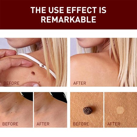 1/2/3pcs Remover Fast Remove All Moles Warts Spots Freckles Anti Foot Corn Removal Warts Papillomas Rapidly Removes Moles