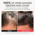 thumbnail image 4 of iRestore Elite - Laser Red Light Therapy for Hair Growth System - FDA Cleared, 4 of 8