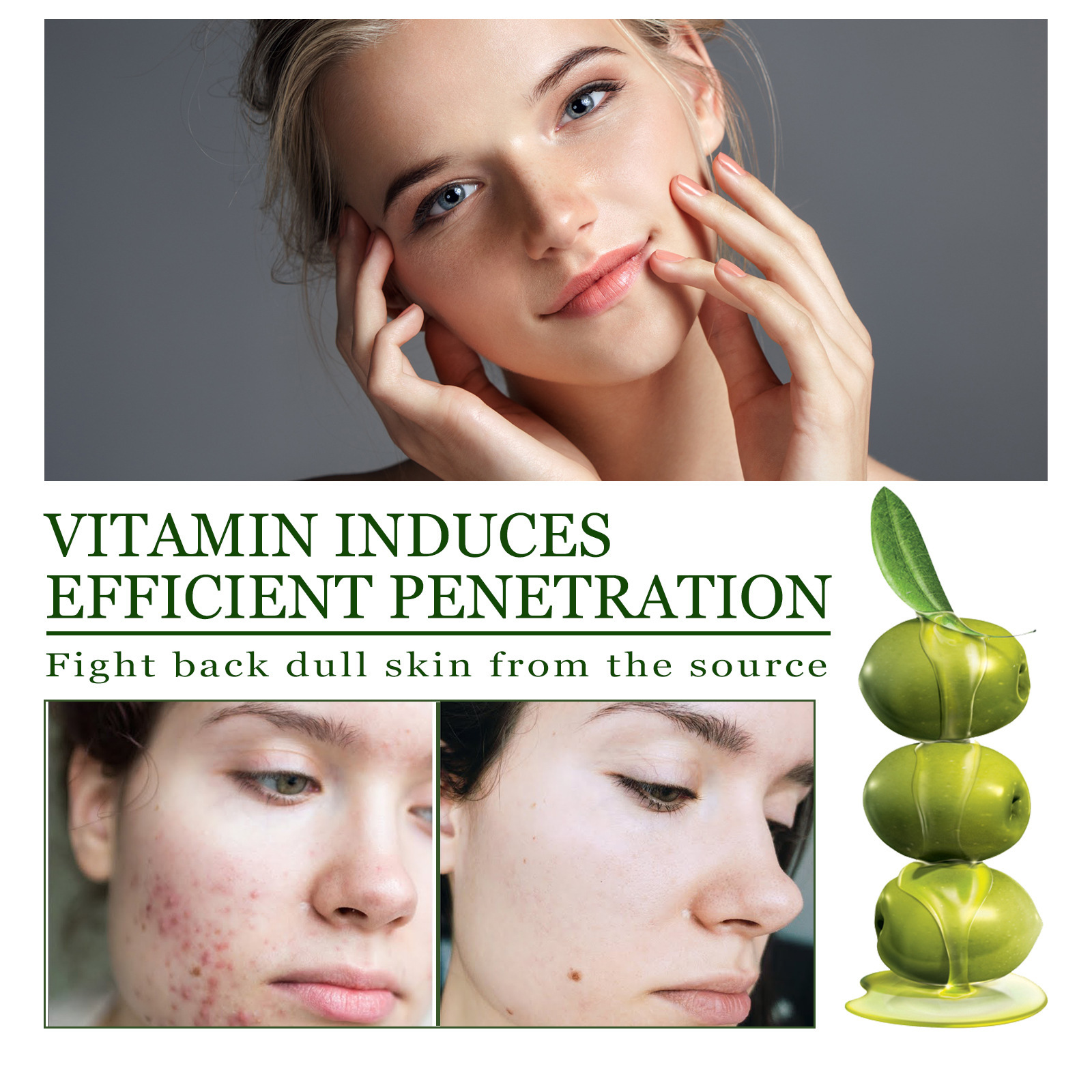 Yoomi Acne Treatment Serum for Face and Body: Targets Cystic, Hormonal ...