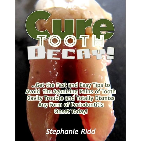 Cure Tooth Decay! : Get the Fast and Easy Tips to Avoid the Agonizing Pains of Tooth Cavity Trouble and Totally Dismiss Any Form of Periodontitis Onset Today! -