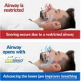 thumbnail image 4 of VitalSleep Anti-Snoring Mouthpiece - Customizable with Teeth Impressions, Adjustable Jaw Positioning, 4 of 5