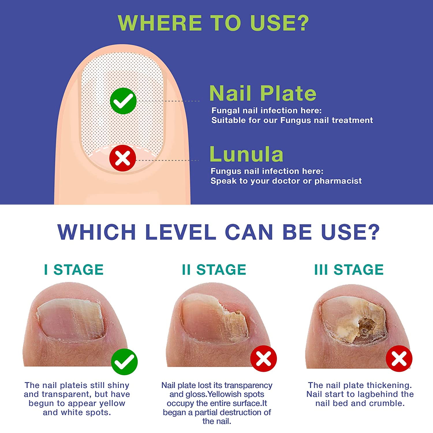 Podiatry Care Specialists - Toenail fungus is an infection that is  contagious and often difficult to get rid of. While some patients may  experience a mild case and barely even notice the