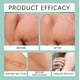 thumbnail image 5 of Advanced Silicone Scar Gel Scar Cream Silicone Scar Gel For Surgical Scars C-Section Stretch Marks Injury Burns 50g, 5 of 5