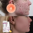 thumbnail image 4 of Honey Acne Extract Acne Removal Marks Facial, 4 of 5