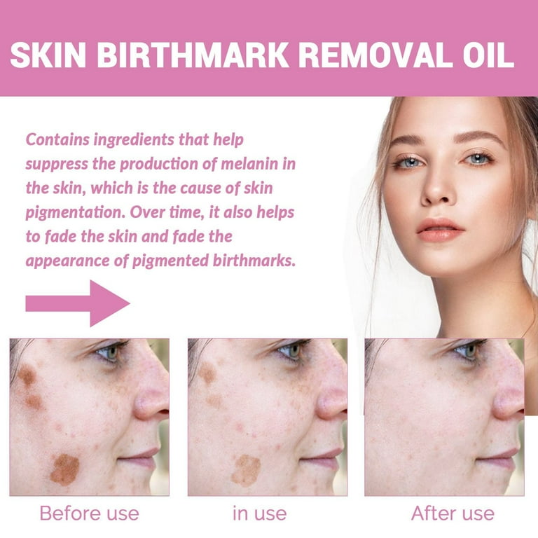 Birthmark removal 2024