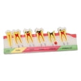thumbnail image 1 of Modelo de caries dental, 6 etapas diferentes, modelo de exhibición de dientes cariados de resina, 1 of 8